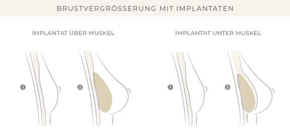 Brustvergrößerung, Dr. Eugenia Remmel, Plastische Chirurgie Zürich